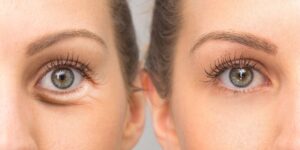 Bags-Under-Eyes-copy - Daily Health Tips: Simple Tricks for a Healthier Life Puffy Eyes