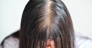 greasy_hair - Daily Health Tips: Simple Tricks for a Healthier Life Greasy Hair